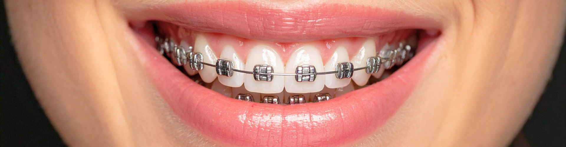 Girl's smile with braces.